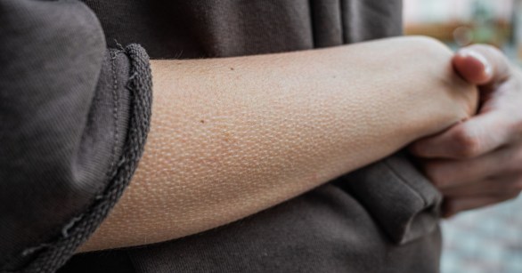Arm with goosebumps