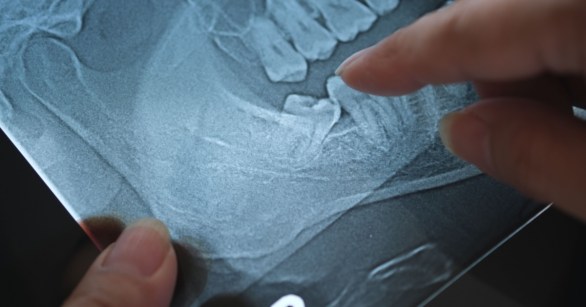 dental xray showing wisdom teeth
