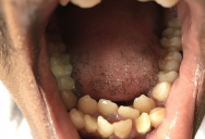 How Many Teeth Are Human Adults Supposed To Have And What Is It Called When They Have Too Many?