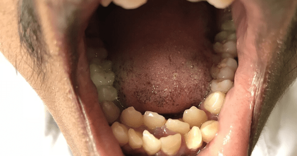 Patient with Hyperdontia