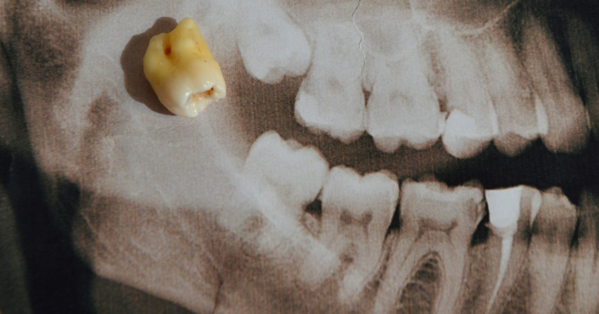 xray of teeth with real tooth