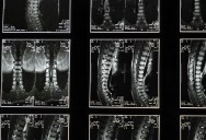 Japanese Doctors Develop Stem Cell Treatment That Helps Paralyzed Man To Learn To Walk Again