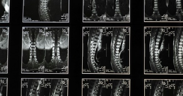 Tiled spinal X Rays