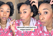 Woman Wasn’t Impressed After She Used Minoxidil For Hair Growth. – ‘Once I got done using it, took away more hair than it gave?’