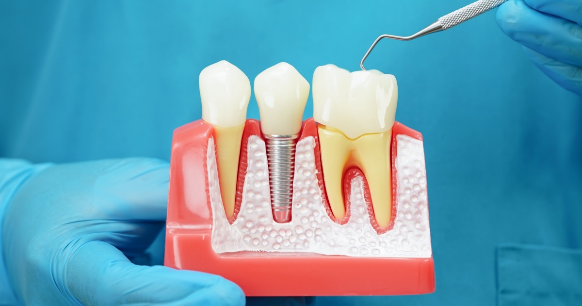 Model of dental implants