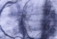 New Study May Reveal Why Some Patients Have Severe Reactions To MRI Contrast Dye, And How To Avoid It