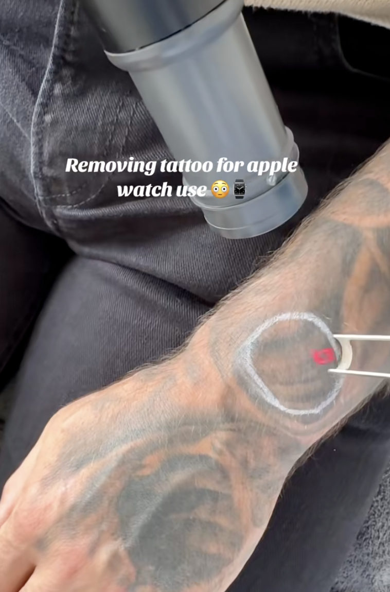 tattoo removal on a man