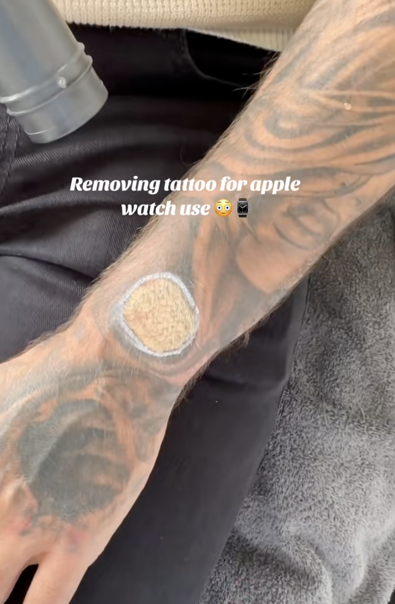 tattoo removal on a man