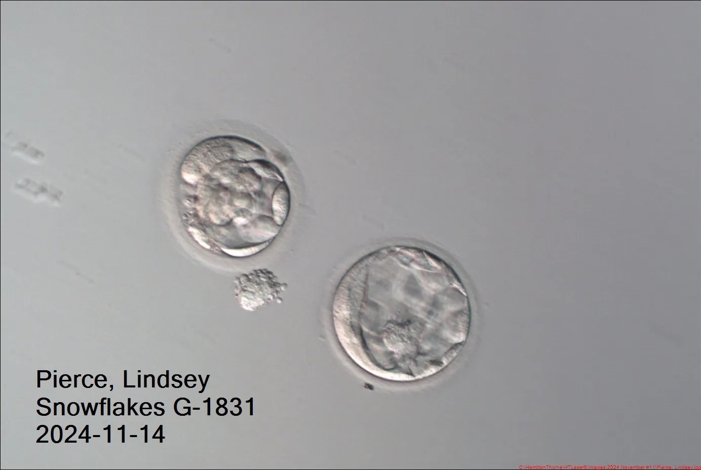 The two embryos that were implanted into Lindsey's uterus