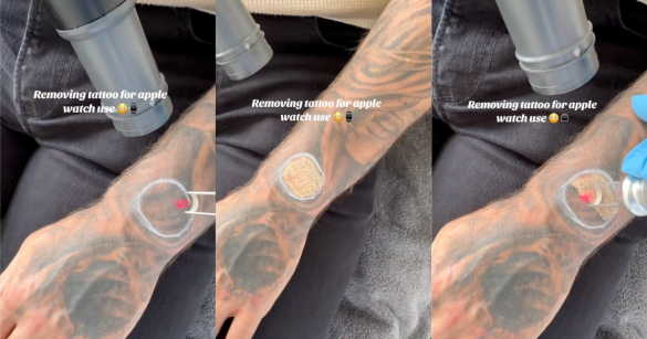 man getting tattoos removed
