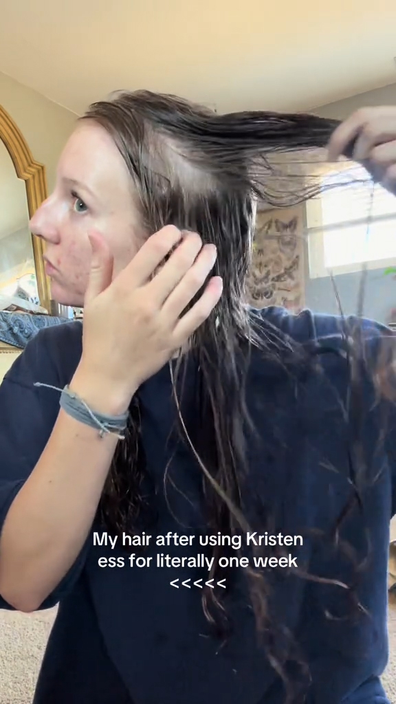 A girl demonstrating her hair loss