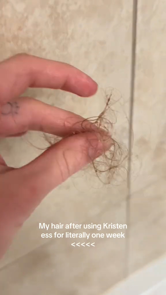 A girl demonstrating her hair loss