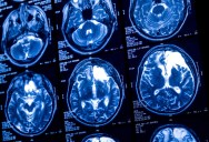 Experimental Brain Stimulation Treatment Leads Chronically Depressed Patient To Report Feeling Overwhelming Joy