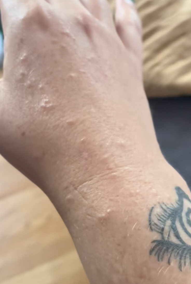woman with bedbug bites
