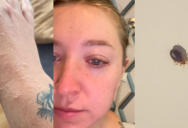 An American Traveler’s Hotel Room In Paris Was Infested With Bedbugs