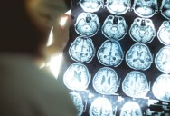 Experimental Brain Stimulation Procedure As Man Suffering From Chronic Depression For Over 30 Years Reporting That He Feels Overwhelming Joy