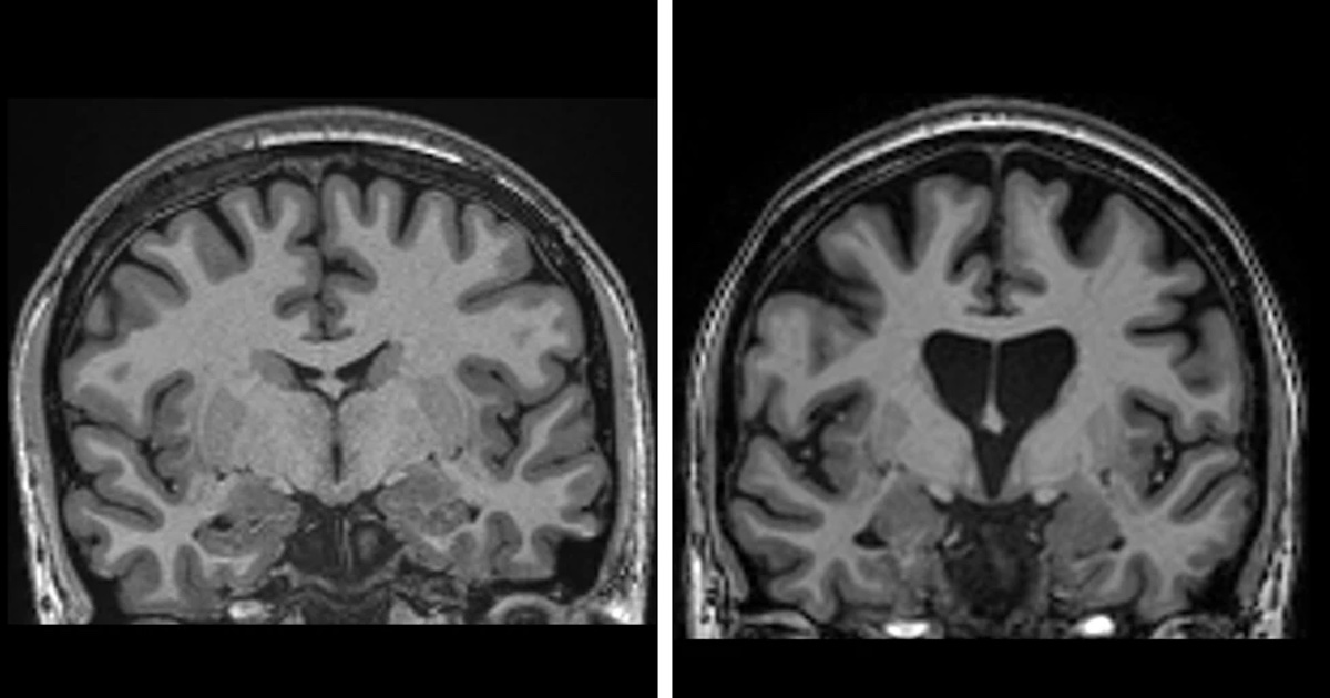Scans of Huntington's and non Huntington's brains