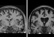 Emotional Doctors Reveal New Treatment For Once Incurable Brain Condition Has A 75% Success Rate