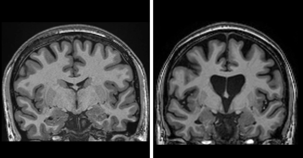 Scans of Huntington's and non Huntington's brains