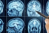 Woman Born With Extremely Rare Condition Resulting In Her Having Virtually No Brain Celebrates Her 20th Birthday, A Remarkably Rare Achievement