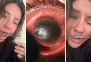 Most People Don’t Appreciate What They Have Until It’s Gone, And One TikToker Who Is Now Blind In One Eye Due To A Parasite Wants To Remind Everyone To Be Grateful