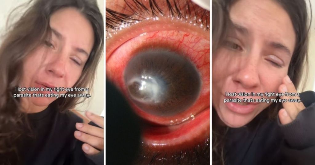 Woman with eye parasite