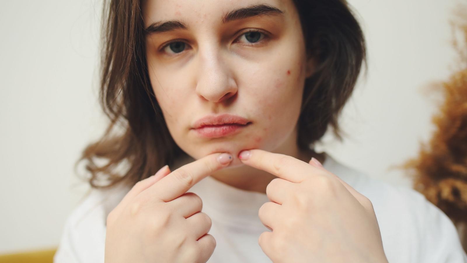 girl with acne touching her face